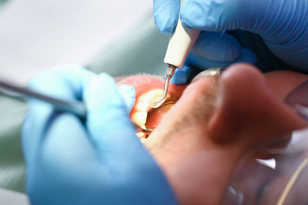 Best Chipped Tooth Repair Near Me  in Canton, MS